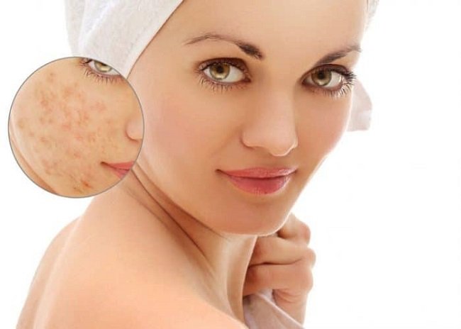 acne and blisters vijayaprabha