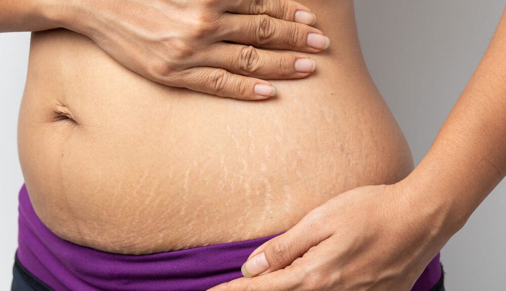 stretchmarks vijayaprabha news