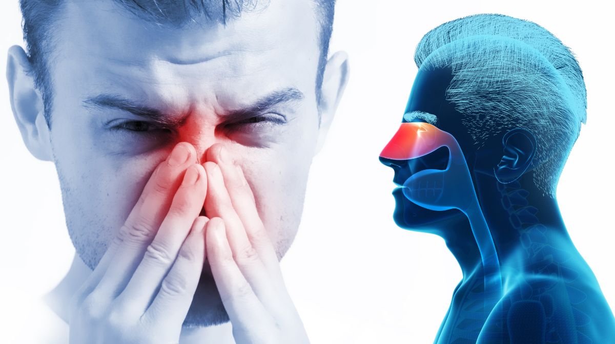 Sinusitis disease